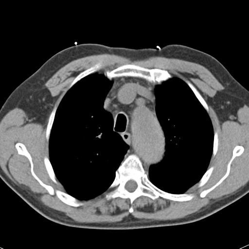 File:Aortic intramural hematoma (Radiopaedia 31139-31838 Axial non-contrast 15).jpg