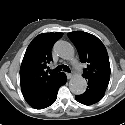 Aortic intramural hematoma (Radiopaedia 31139-31838 Axial non-contrast 22).jpg