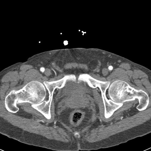 Aortic intramural hematoma (Radiopaedia 31139-31838 B 167).jpg
