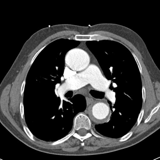 Aortic intramural hematoma (Radiopaedia 31139-31838 B 41).jpg