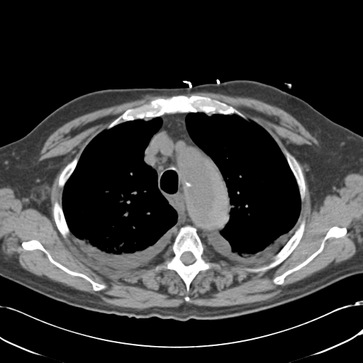 Aortic intramural hematoma (Radiopaedia 34260-35540 Axial non-contrast 17).png