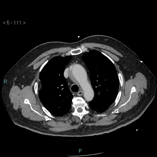 Aortic intramural hematoma (Radiopaedia 48463-53380 C 51).jpg