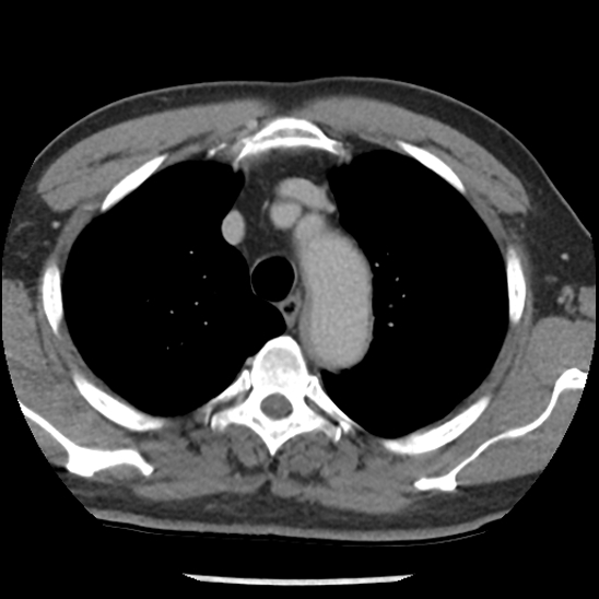 File:Aortic intramural hematoma (type B) (Radiopaedia 79323-92387 Axial C+ delayed 11).jpg