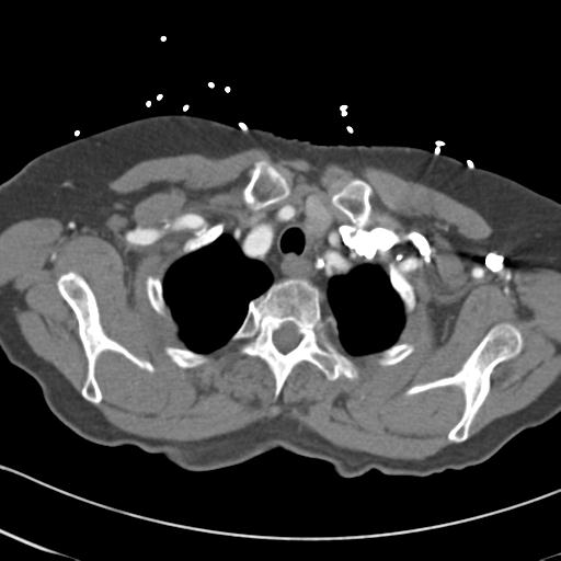 Aortic intramural hematoma from penetrating atherosclerotic ulcer (Radiopaedia 31137-31836 A 8).jpg