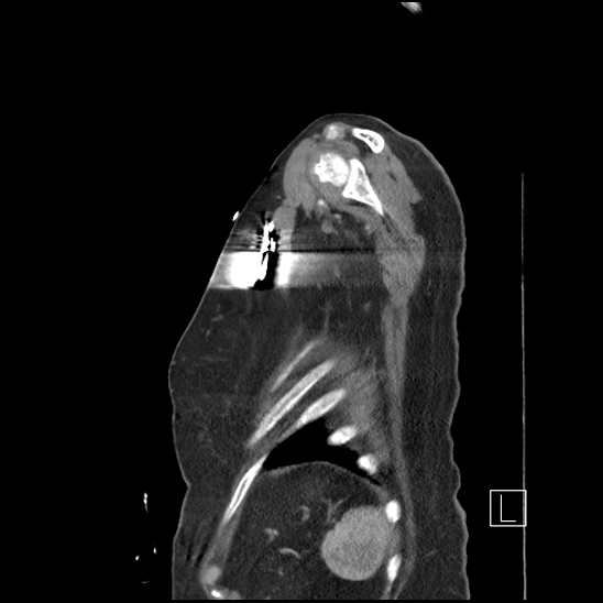 Aortic intramural hematoma with dissection and intramural blood pool (Radiopaedia 77373-89491 D 83).jpg