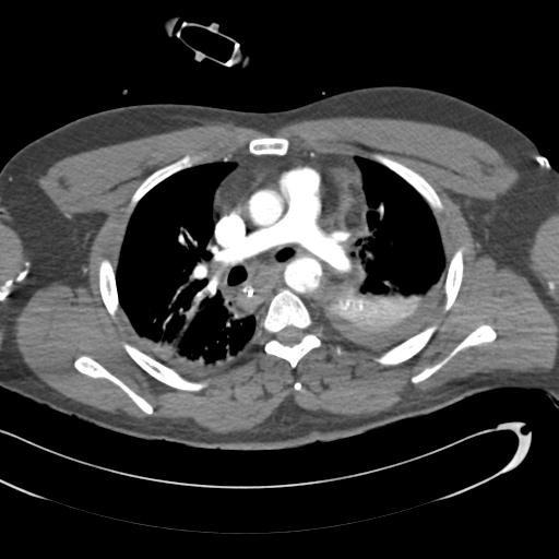 Aortic transection, diaphragmatic rupture and hemoperitoneum in a complex multitrauma patient (Radiopaedia 31701-32622 A 37).jpg