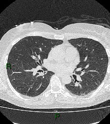 File:Aortic valve endocarditis (Radiopaedia 87209-103485 Axial lung window 53).jpg