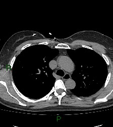 Aortic valve endocarditis (Radiopaedia 87209-103485 Axial non-contrast 35).jpg