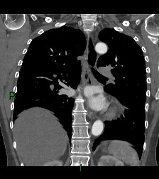 File:Aortic valve endocarditis (Radiopaedia 87209-103485 D 27).jpg