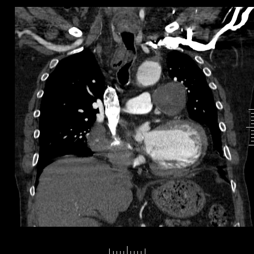 File:Aorto-coronary bypass graft aneurysms (Radiopaedia 40562-43157 B 20).png