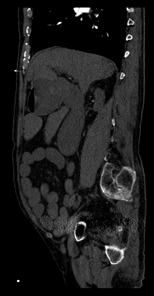 Aortoduodenal fistula (Radiopaedia 75286-86415 F 43).jpg