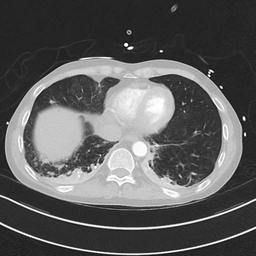 Apical bullous disease in a heavy smoker (Radiopaedia 33067-34092 Axial lung window 47).png