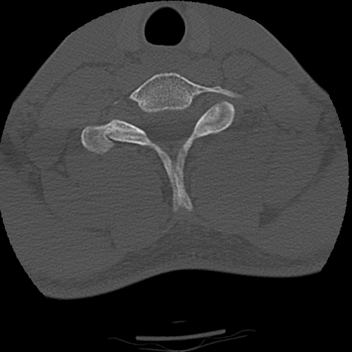 Apical pneumothorax on cervical spine CT (Radiopaedia 45343-49368 Axial bone window 71).jpg
