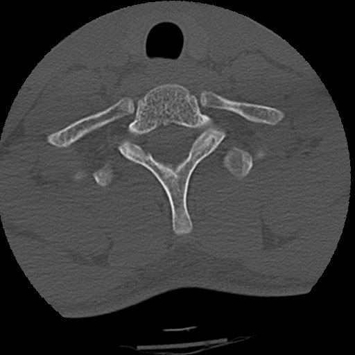 File:Apical pneumothorax on cervical spine CT (Radiopaedia 45343-49368 Axial bone window 78).jpg