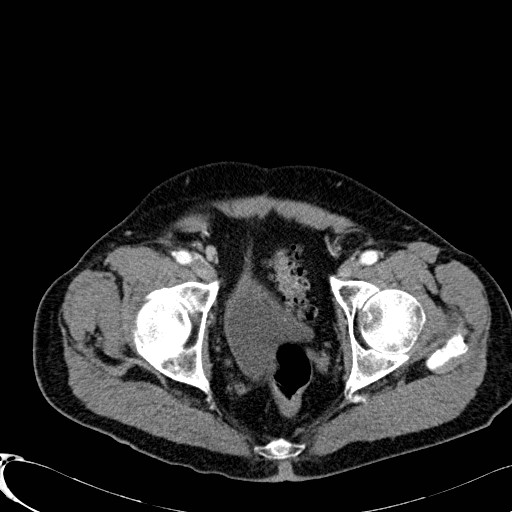 File:Appendiceal adenocarcinoma complicated by retroperitoneal abscess (Radiopaedia 58007-65039 B 132).jpg