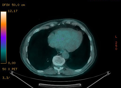 Appendiceal adenocarcinoma complicated by retroperitoneal abscess (Radiopaedia 58007-65041 Axial PET-CT 90).jpg