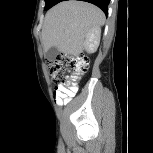 Appendicitis complicated by post-operative collection (Radiopaedia 35595-37114 C 21).jpg