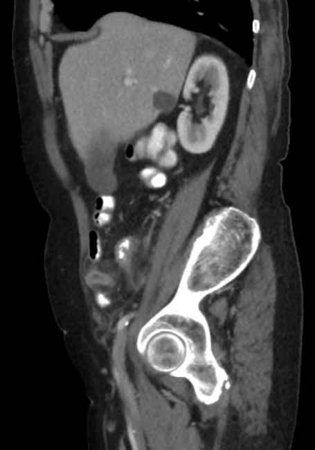 Appendicitis due to chicken fibula (Radiopaedia 74314-85198 C 29).jpg