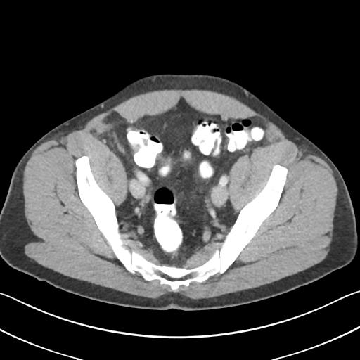Appendicitis with cecal bar sign (Radiopaedia 31878-32830 B 67).jpg