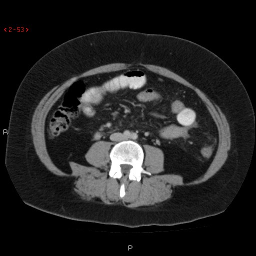 Appendicitis with microperforation- promontoric type (Radiopaedia 27268-27442 C 41).jpg