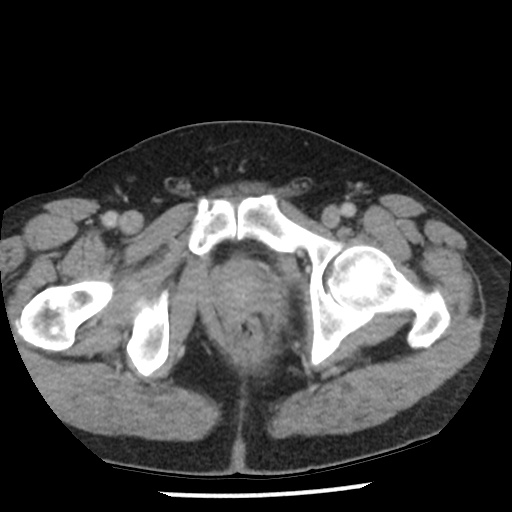 Appendicitis with perforation (Radiopaedia 35790-37342 A 52).jpg