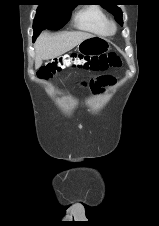 Appendicitis with thickening of the terminal ileum (Radiopaedia 42432-45550 B 9).png