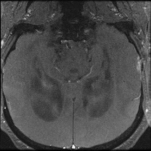 Aqueduct stenosis with corpus callosum hypoattenuation post shunting (Radiopaedia 37212-38969 Axial CSF Flow 53).png