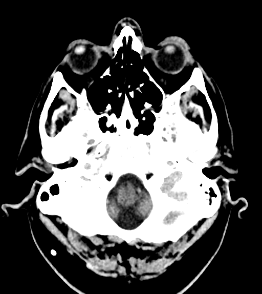 File:Aqueduct stenosis with corpus callosum hypoattenuation post shunting (Radiopaedia 37212-38971 Axial non-contrast 3).png