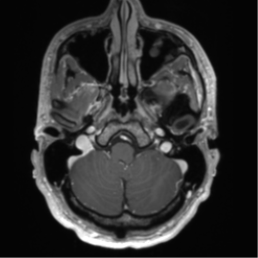 Arachnoid cyst with subdural hematoma (Radiopaedia 85892-101743 Axial T1 C+ 18).png
