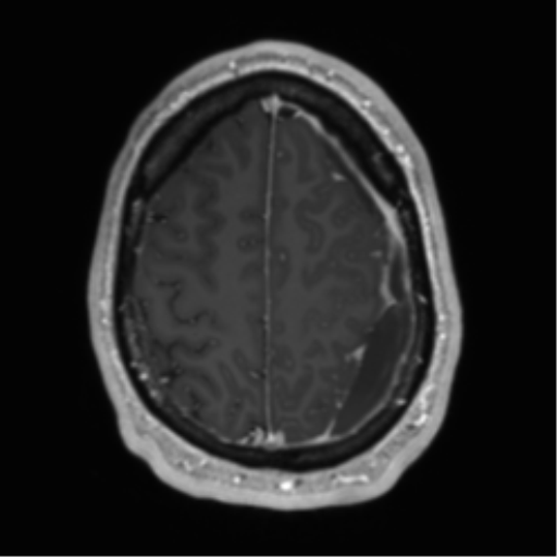 Arachnoid cyst with subdural hematoma (Radiopaedia 85892-101743 Axial T1 C+ 68).png