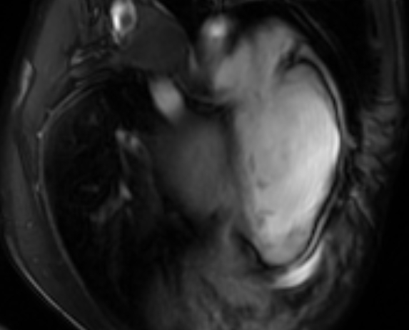 Arrhythmogenic right ventricular cardiomyopathy (Radiopaedia 69564-79464 4ch cine 122).jpg