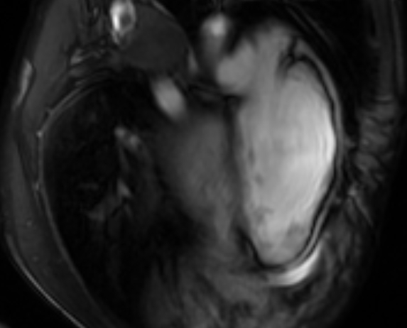File:Arrhythmogenic right ventricular cardiomyopathy (Radiopaedia 69564-79464 4ch cine 140).jpg