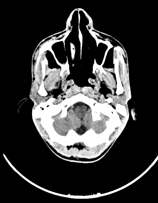 Arrow injury to the brain (Radiopaedia 72101-82607 Axial non-contrast 51).jpg