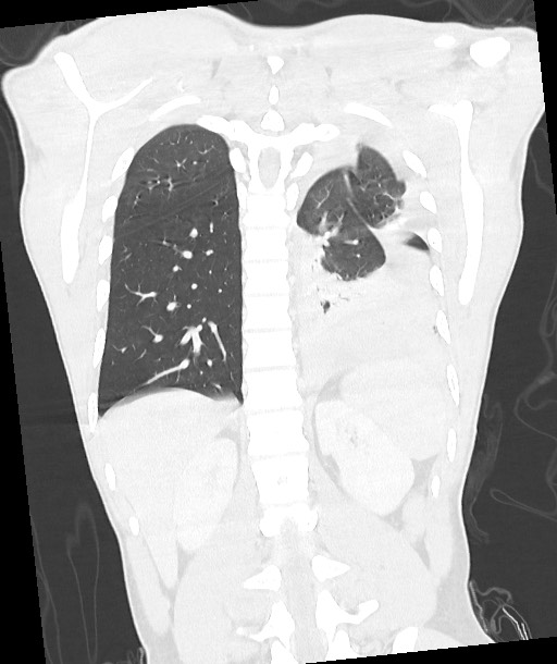 Arrow injury to the chest (Radiopaedia 85367-100975 Coronal lung window 98).jpg