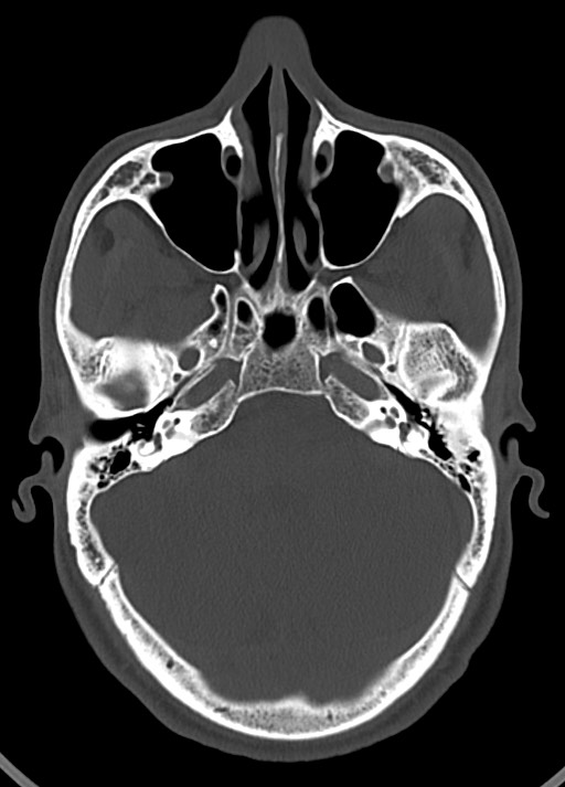 Arrow injury to the head (Radiopaedia 75266-86388 Axial bone window 53).jpg