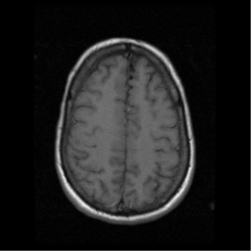 File:Arteriovenous malformation (cerebral) (Radiopaedia 40070-42580 Axial T1 17).png