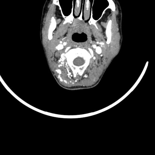 Arteriovenous malformation of the neck (Radiopaedia 53935-60062 A 53).jpg