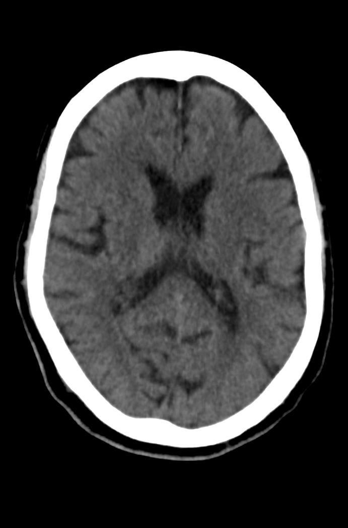 Artery of Percheron infarction (Radiopaedia 80613-94202 Axial non-contrast 110).jpg