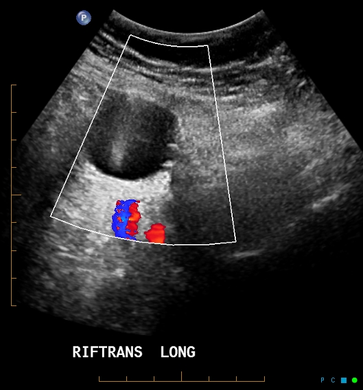 File:Artificial urethral sphincter (Radiopaedia 46937-51465 colour Doppler 1).jpg