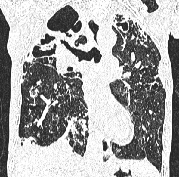 Aspergilloma- with Monod sign (Radiopaedia 44737-48532 Coronal lung window 247).jpg