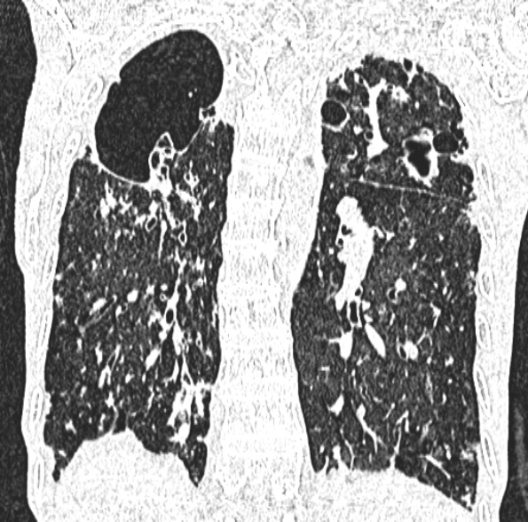 Aspergilloma- with Monod sign (Radiopaedia 44737-48532 Coronal lung window 322).jpg