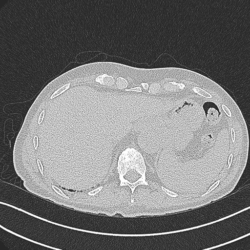 File:Aspergilloma on background pulmonary fibrosis (Radiopaedia 60942-68757 B 48).jpg