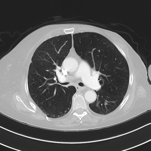 Aspiration bronchiolitis (Radiopaedia 53464-59463 Axial lung window 24).png