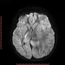 Astroblastoma (Radiopaedia 74287-85162 Axial DWI 53).jpg