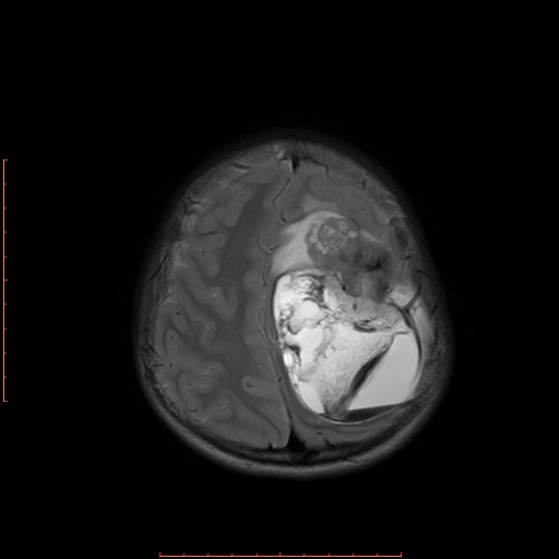File:Astroblastoma (Radiopaedia 74287-85162 Axial T2 18).jpg