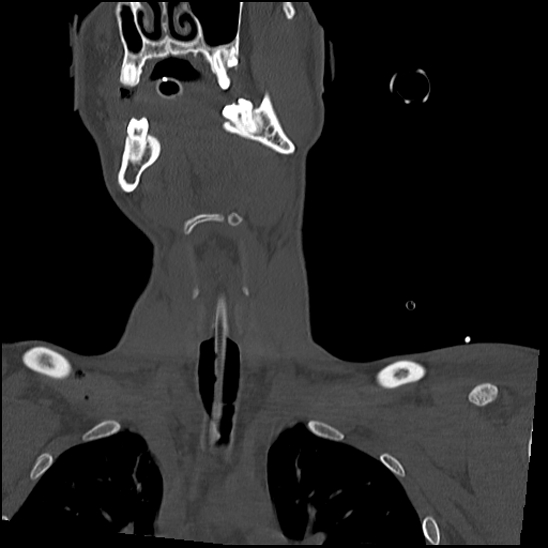Atlanto-occipital dissociation (Traynelis type 1), C2 teardrop fracture, C6-7 facet joint dislocation (Radiopaedia 87655-104061 Coronal bone window 18).jpg