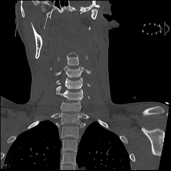 Atlanto-occipital dissociation (Traynelis type 1), C2 teardrop fracture, C6-7 facet joint dislocation (Radiopaedia 87655-104061 Coronal bone window 35).jpg