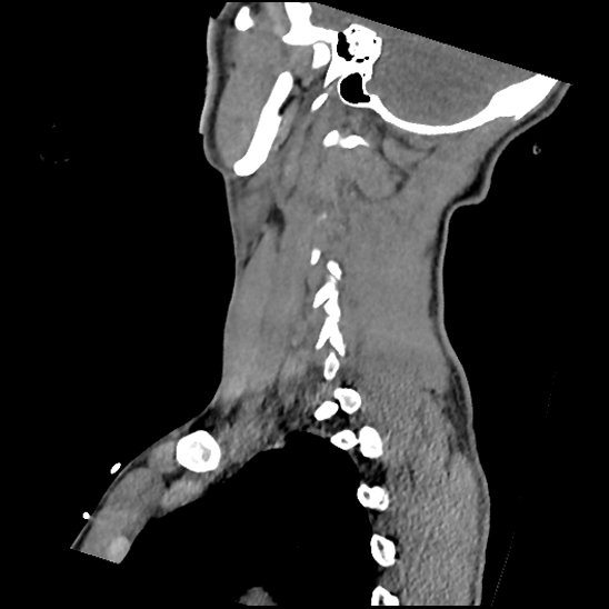 Atlanto-occipital dissociation (Traynelis type 1), C2 teardrop fracture, C6-7 facet joint dislocation (Radiopaedia 87655-104061 D 62).jpg