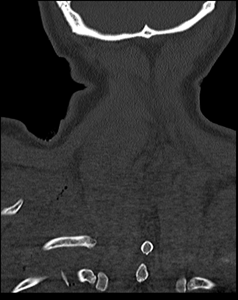 Atlanto-occipital dissociation - Traynelis type 1 (Radiopaedia 87570-103948 Coronal bone window 54).jpg