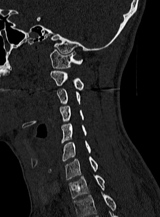 Atlantoaxial subluxation (Radiopaedia 44681-48450 Sagittal bone window 110).jpg